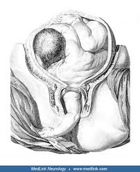 Image result for Shoulder Presentation