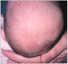 Hair loss cannot be completely prevented, but your baby's hair loss can be reduced with nutrition and medication. Photo Essay Childhood Alopecia Consultant360