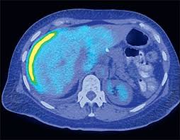 This is because you may have inherited a brca1/2 gene mutation. Should We Or Should We Not Secondary Debulking In Ovarian Cancer The Lancet Oncology