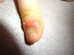 Image result for Akutní zánět nehtového lůžka