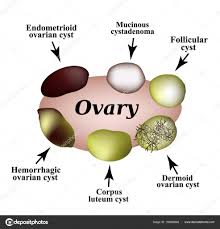 Types Of Ovarian Cysts Set Infographics Vector