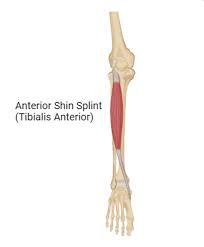 Image result for Shin Splints
