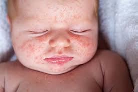 Image result for yellow scabs on the face in children