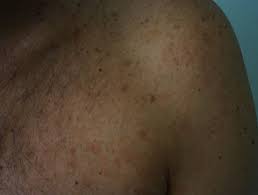 Pityriasis alba, a relatively common skin disorder in children and young adults, is characterized by the pityriasis alba lesions often occur on the face, with the cheek being a particularly common site. Definiciones Dermatologia Archives Seite 38 Von 233 Dermatly Com El Sitio De Tu Piel