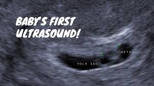 A number of factors — like your baby's position in your uterus, how tall you. Baby S First Ultrasound 6 Weeks Pregnant Youtube