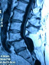 Resultado de imagen de abultamiento dinámico del disco en la columna lumbar