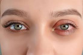 Image result for Allergic Conjunctivitis