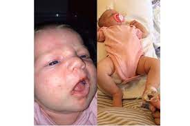 Mum S Facebook Warning To Other Parents After Newborn Baby Develops Herpes Virus Madeformums