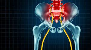 Spinalkanalstenose Symptome Ursachen Behandlung Ndr De Ratgeber Gesundheit
