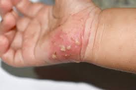 Image result for scabies transmission