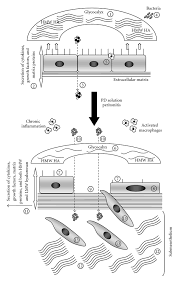 Around 9 out of 10 (90%) mesotheliomas. Figure 1 Pathophysiology Of The Peritoneal Membrane During Peritoneal Dialysis The Role Of Hyaluronan