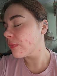 What product is best for redness