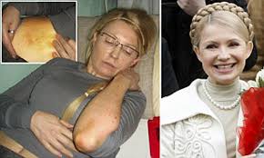 Check spelling or type a new query. Yulia Tymoshenko Prison Pictures Show Former Ukrainian Pm And Orange Revolution Heroine S Bruises Daily Mail Online