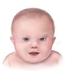 Down Syndrome Wikipedia