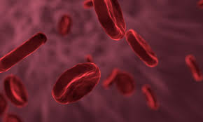 Sickle cell disease (scd) and its variants are genetic disorders resulting from the presence of a mutated form of hemoglobin, hemoglobin s (hbs) (see the image below). Sickle Cell Anemia Is An Inherited Form Of Anemia