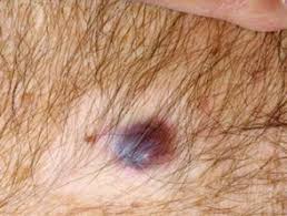 Breast cancer most commonly spreads to the bones, liver, lungs, and brain. Cutaneous Metastasis Dermnet Nz