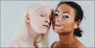Vitiligo