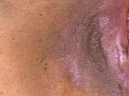 It is uncommon in men and children. Emerging Treatments For Vulvar Lichen Sclerosus Offer Promising Alternatives To Ultrapotent Corticosteroids Dermatology Advisor