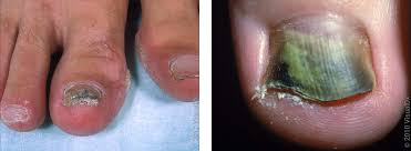 Image result for onychomycosis