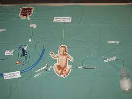 Exchange Transfusion In The Neonate