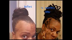 Beautiful hair is your birthright. Bald Edges What I Used To Grow My Edges Back Fast 4 Month Update Youtube
