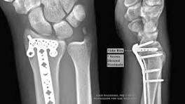 Distal Radius Fractures Involving The Volar Rim ...