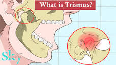 What is Trismus? - Symptoms, Causes and Treatment