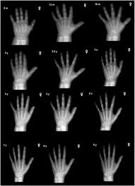 Predicting Height By Bone Age An Inexact Science