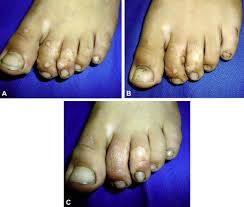 Sa is thought to work by promoting exfoliation of epidermal cells; Switching Between Intralesional Antigens A Promising Therapeutic Approach For Recalcitrant Warts Jaad Case Reports