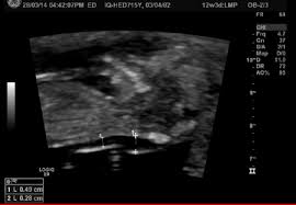 An increased nt measurement does not always mean the baby has a problem but it does increase the risk. Bad Nt Scan 4 9mm October 2014 Babycenter Australia