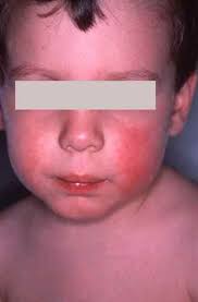 Il s'agit des pays/territoires suivants : Plaques Rouges Du Visage De L Enfant Plaques Qui Demangent Les Joues De Bebe Teleconsultation Dermatologue