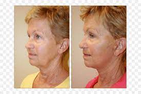 We earn a commission for products purchased through some links in this article. Wange Rhytidectomy Lifestyle Lift Blepharoplastik Mesotherapie Andere Png Herunterladen 770 596 Kostenlos Transparent Kopf Png Herunterladen