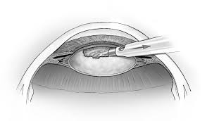 Image result for Cataract Extraction