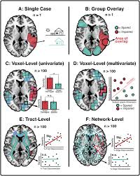 Image result for Neurologic Lesion Localization