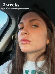 My Lip Filler Transformation Journey: Before & After 💋