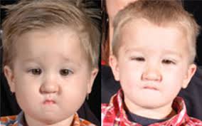 Pierre Robin Sequence Before & After Pictures Dallas, Plano, TX