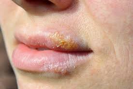 Honig Gegen Herpes