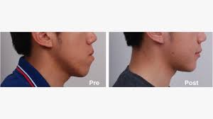 Double Jaw Surgery Benefits Risks Cost Recovery And Pictures
