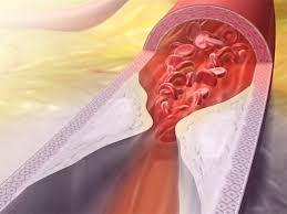 Atherosclerosis: The Anatomy and Physiology of a (Silent) Killer