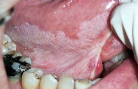 Image result for white cancer on tongue)