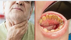 Early signs of oral cancer can be a sore that doesn't heal, a whitish or reddish patch on the lining of the mouth, a lump or thickening of the skin in the mouth, bleeding in the mouth, an earache, a sore. Oncologist Reveals The Causes And Early Signs Of Oral Cancer
