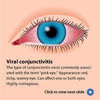 Pink Eye Conjunctivitis Symptoms Causes And Treatments Pink Eyes Pink Eye Symptoms Eye Facts