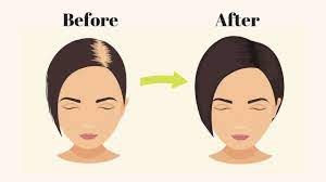 Hair loss in teenage girls can cause emotional trauma at a critical time in their lives. What Causes Hair Fall Ways To Grow Your Hair Naturally Medy Life