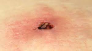 What Bit Me How To Identify Common Bug Bites Everyday Health