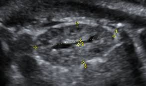 Let's learn the comprehensive information of renal parenchymal disease, including its causes, symptoms, treatment and diets, etc. The Renal Parenchyma Evaluation Of A Novel Ultrasound Measurement To Assess Fetal Renal Development Protocol For An Observational Longitudinal Study Bmj Open