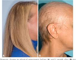 The hair that falls out during chemotherapy almost always grows back. Figure 2 From Chemotherapy Induced Alopecia Semantic Scholar