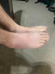 Hello 👋 I'm wondering if anyone could please help me as I've been  suffering for a long time and can't figure out what may be the cause. I've  had joint and swelling