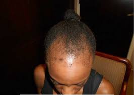 When i got there they already convinced me to have the procedure done. What It S Like To Get Bosley Hair Restoration For Traction Alopecia Plus Tv Divagal S Fave Hair Products Watch Divagalsdaily