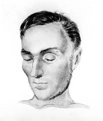 File:Patient with Addison's disease Wellcome M0012690.jpg