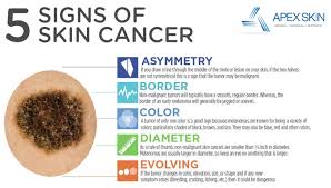 Skin cancer is mostly caused by ultraviolet radiation from sunshine or tanning beds. 8 Common Skin Cancer Questions Answers Apex Dermatology Skin Surgery Center Cleveland Oh Dermatology